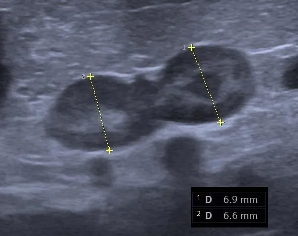 عکس واقعی مرتبط با سندرم کوشینگ: Adrenal gland dog cushing.jpg